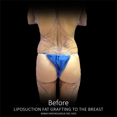 waist reduction surgery before