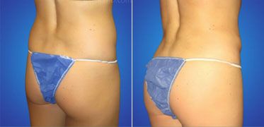 top bbl doctor los angeles