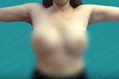 arm reduction liposuction after