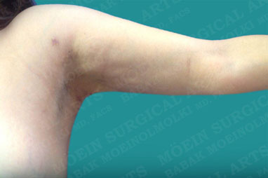 under arm lipo after