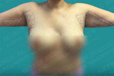 arm reduction liposuction before