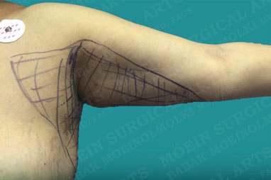 under arm lipo before