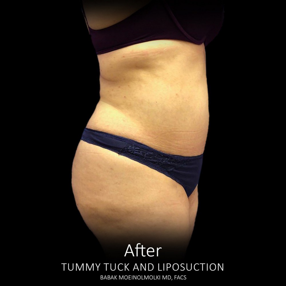 Tummy tuck surgery after