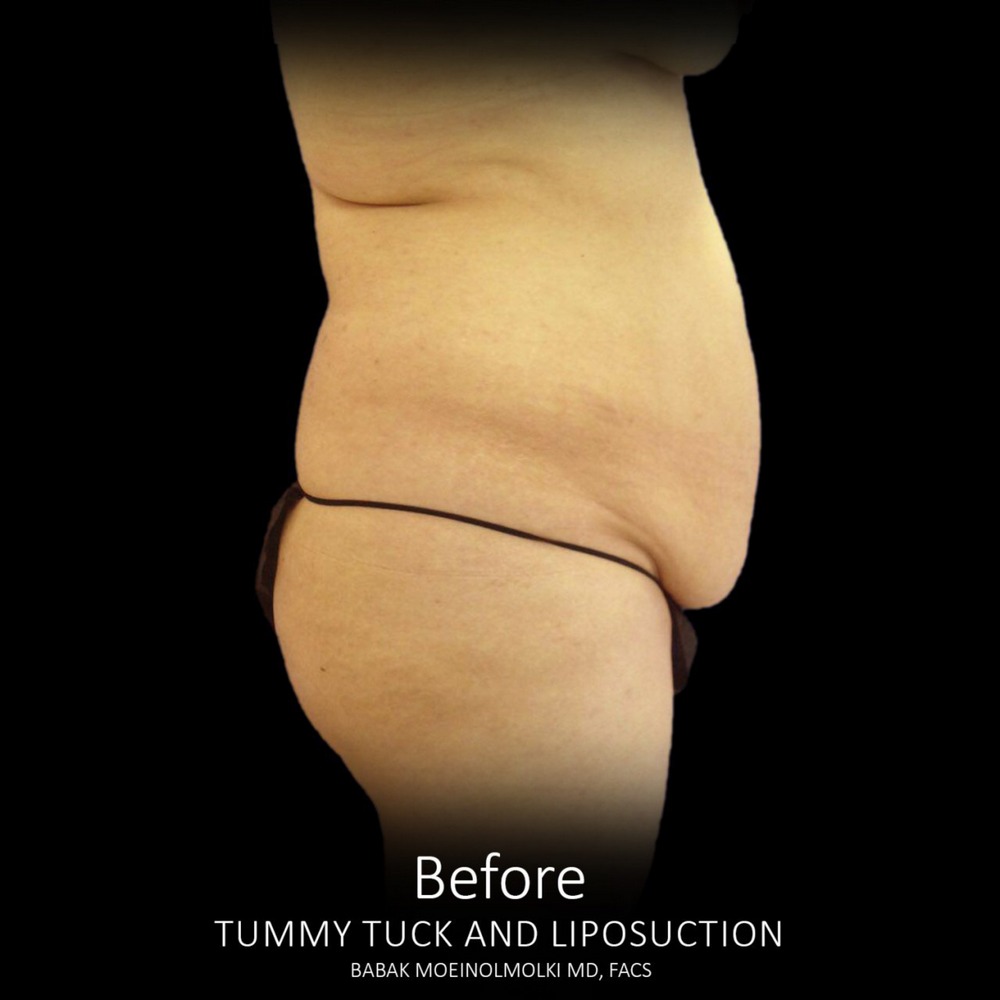 tummy tuck surgery before