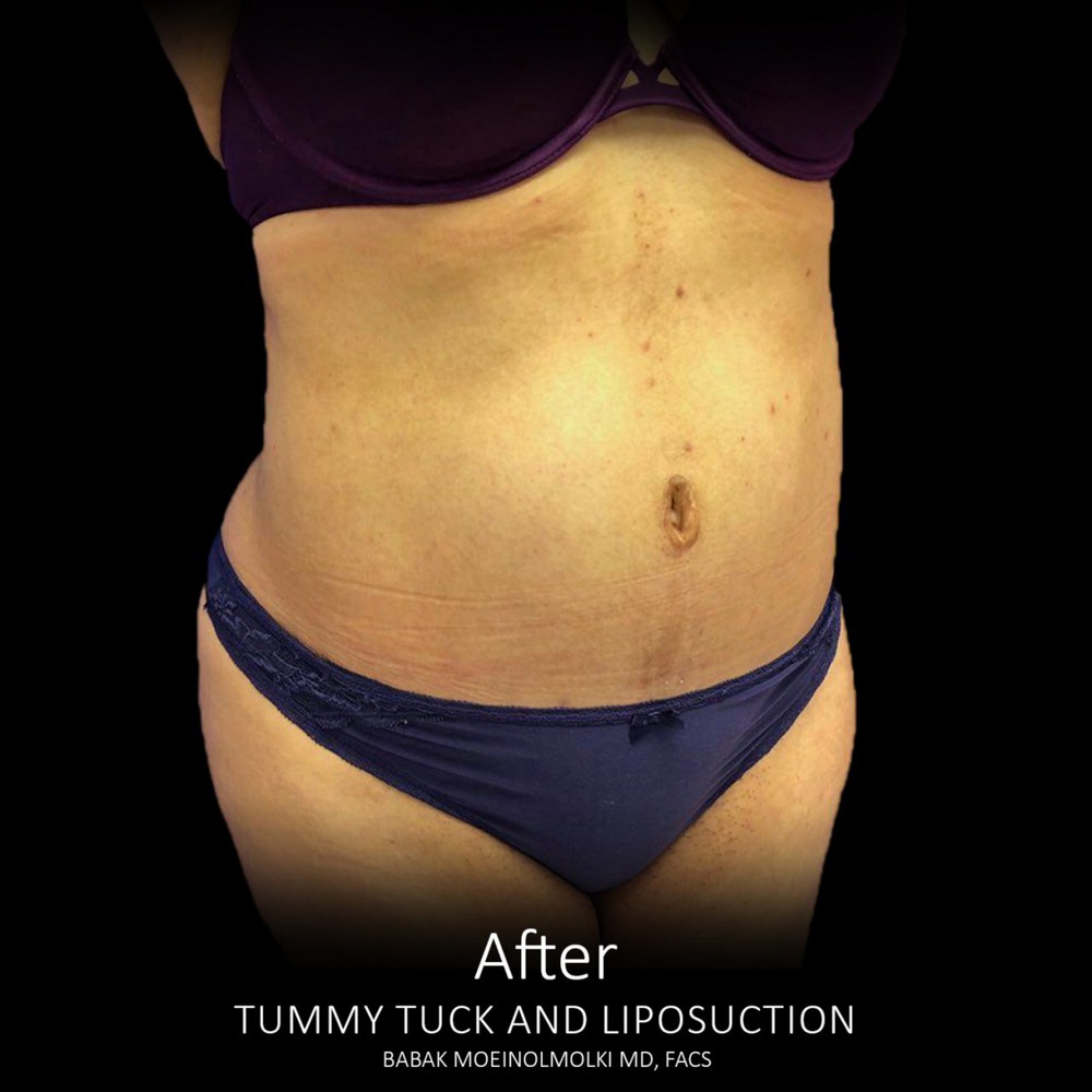 abdominoplasty surgery after