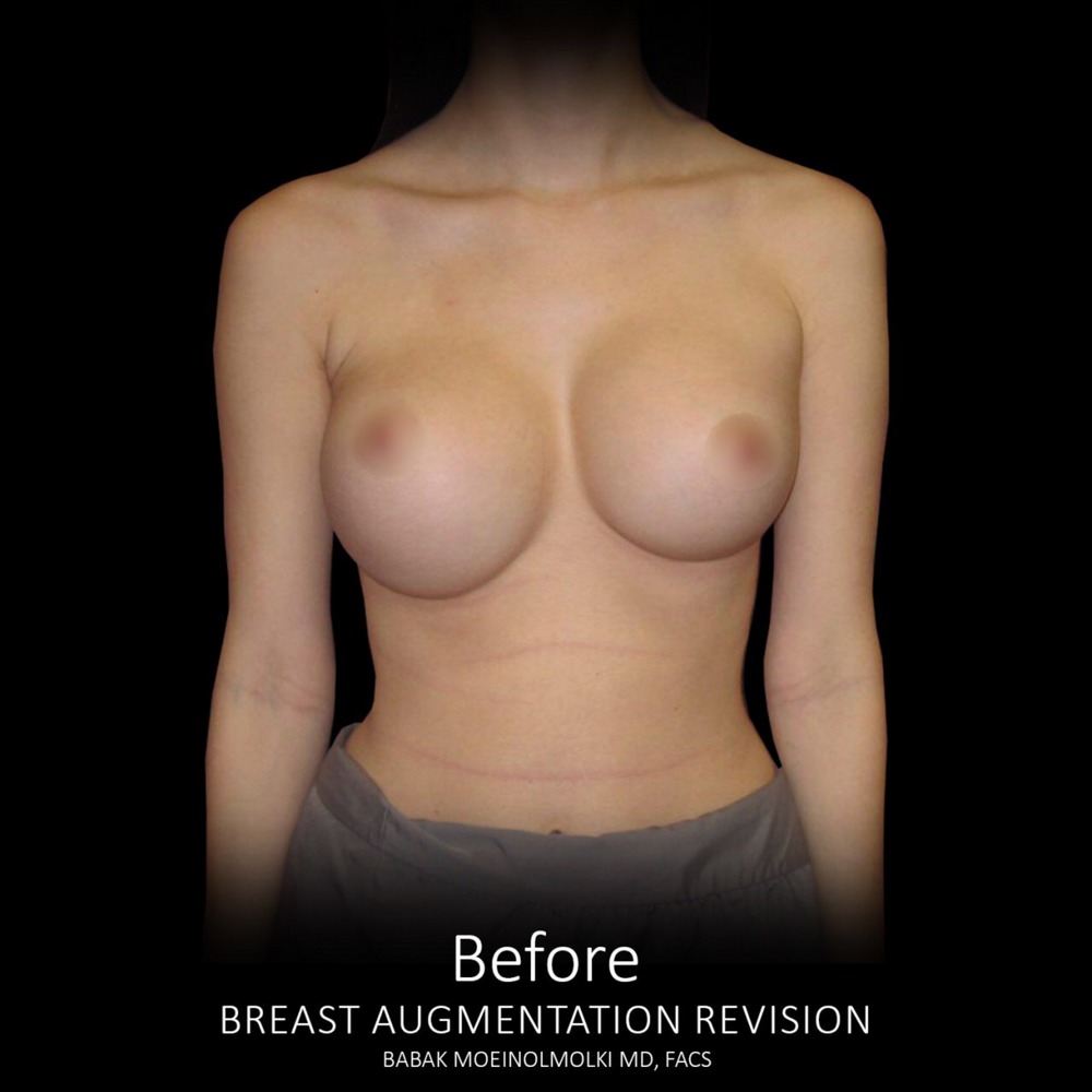 breast implant before revision