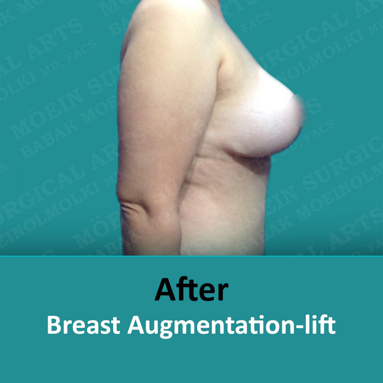 breast lift and augmentation surgery recovery after