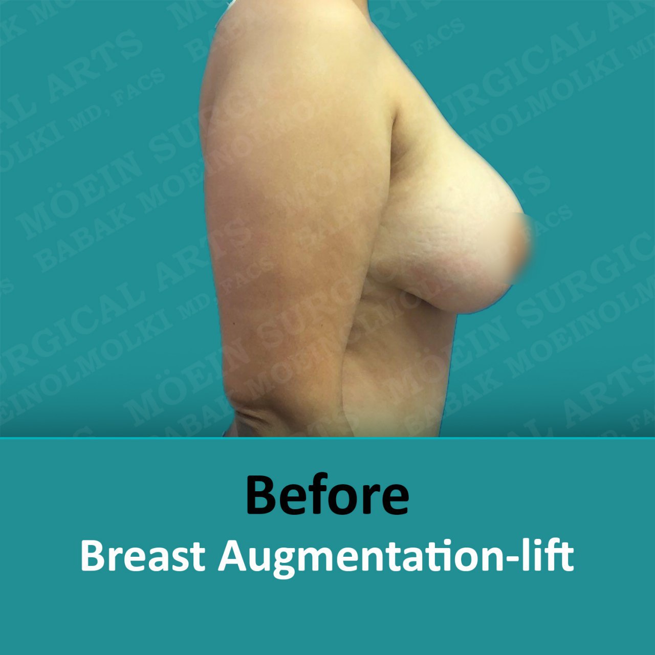 breast lift and augmentation surgery recovery before