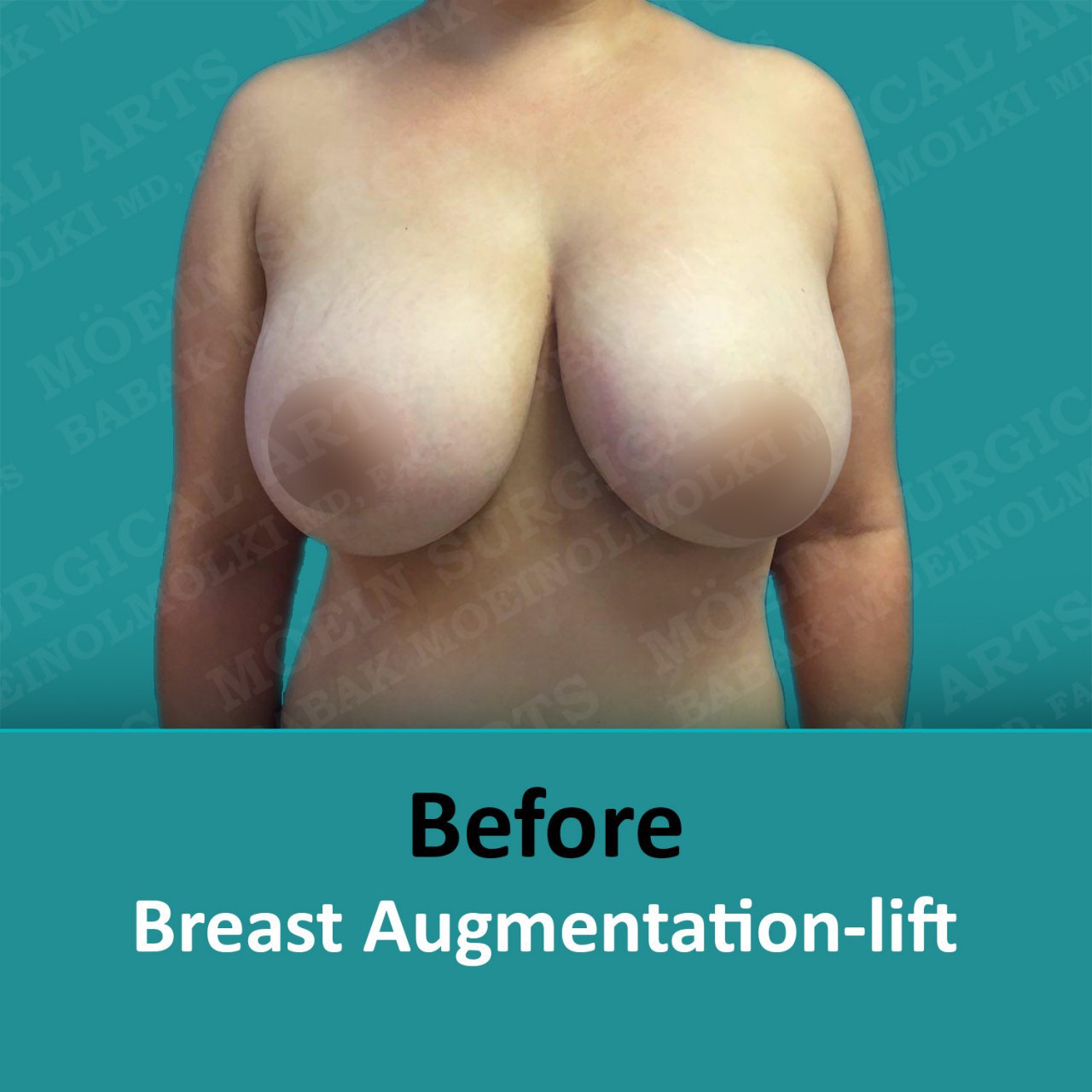 plastic surgery breast lift and augmentation before