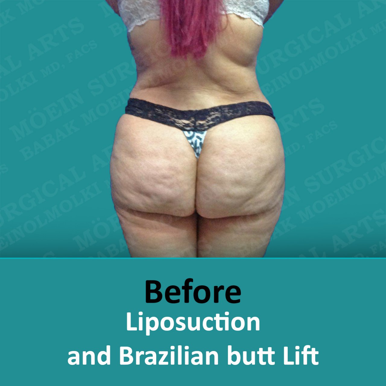 Liposuction and Brazilian butt lift before