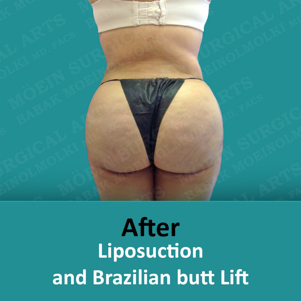 Liposuction and Brazilian butt lift after