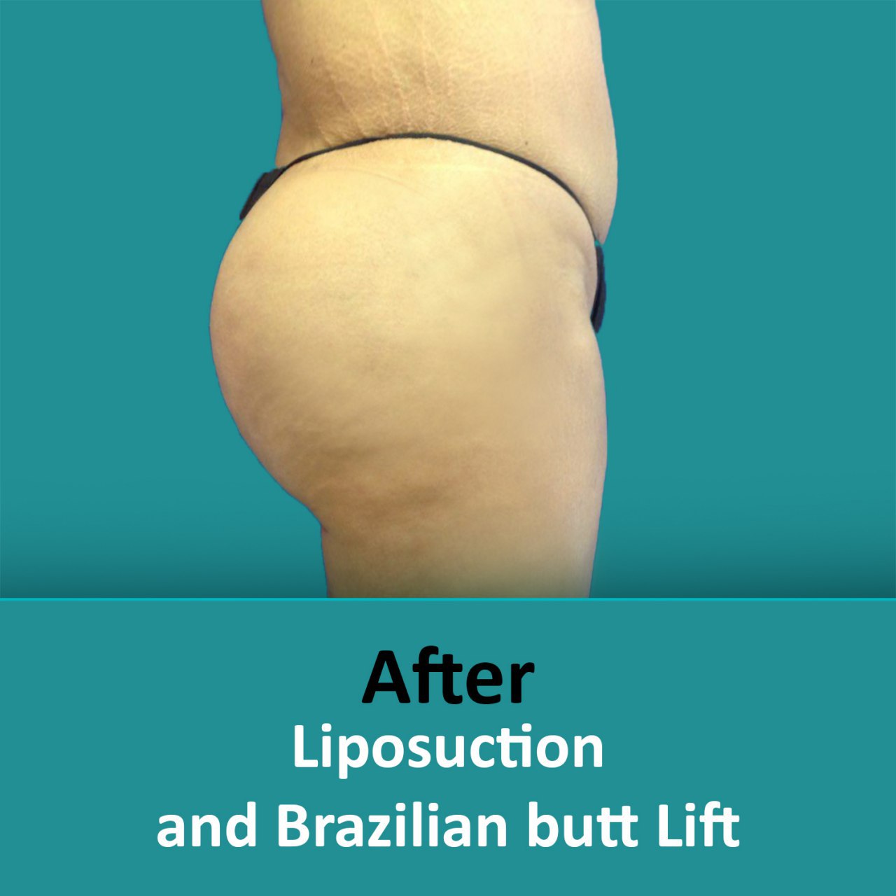 plastic surgery Brazilian butt lift after