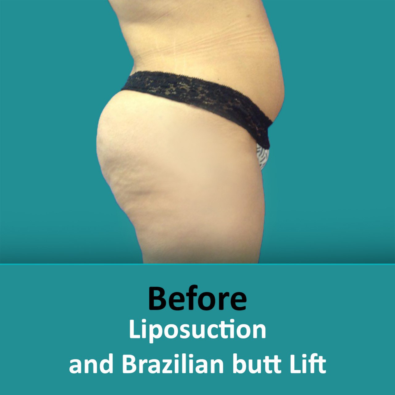 plastic surgery Brazilian butt lift before