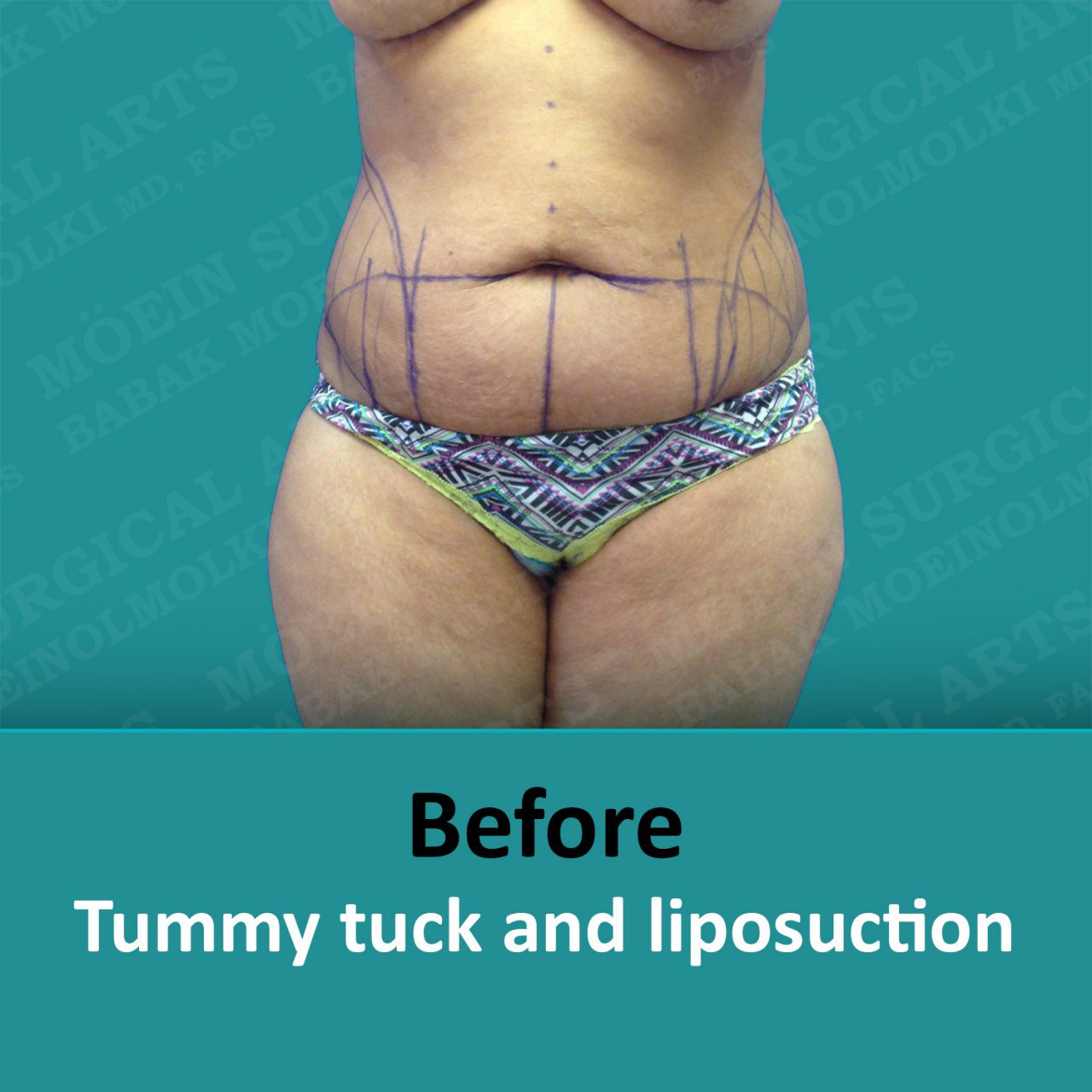tummy tuck surgery before