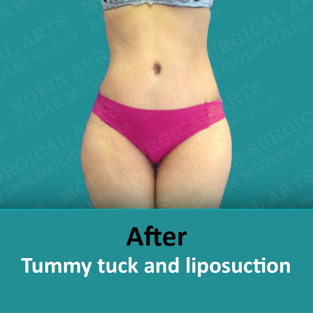 tummy tuck surgery after