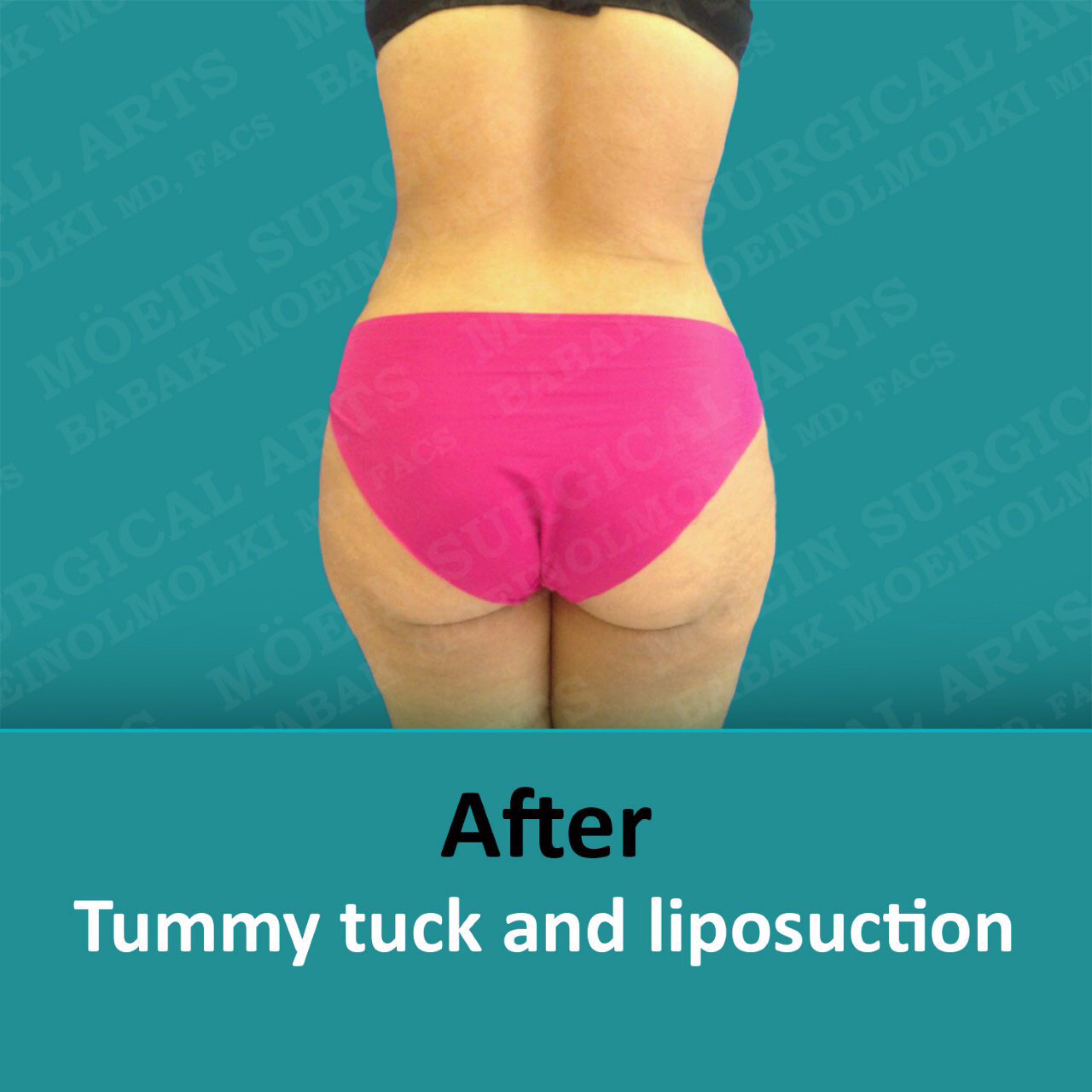 tummy tuck process after