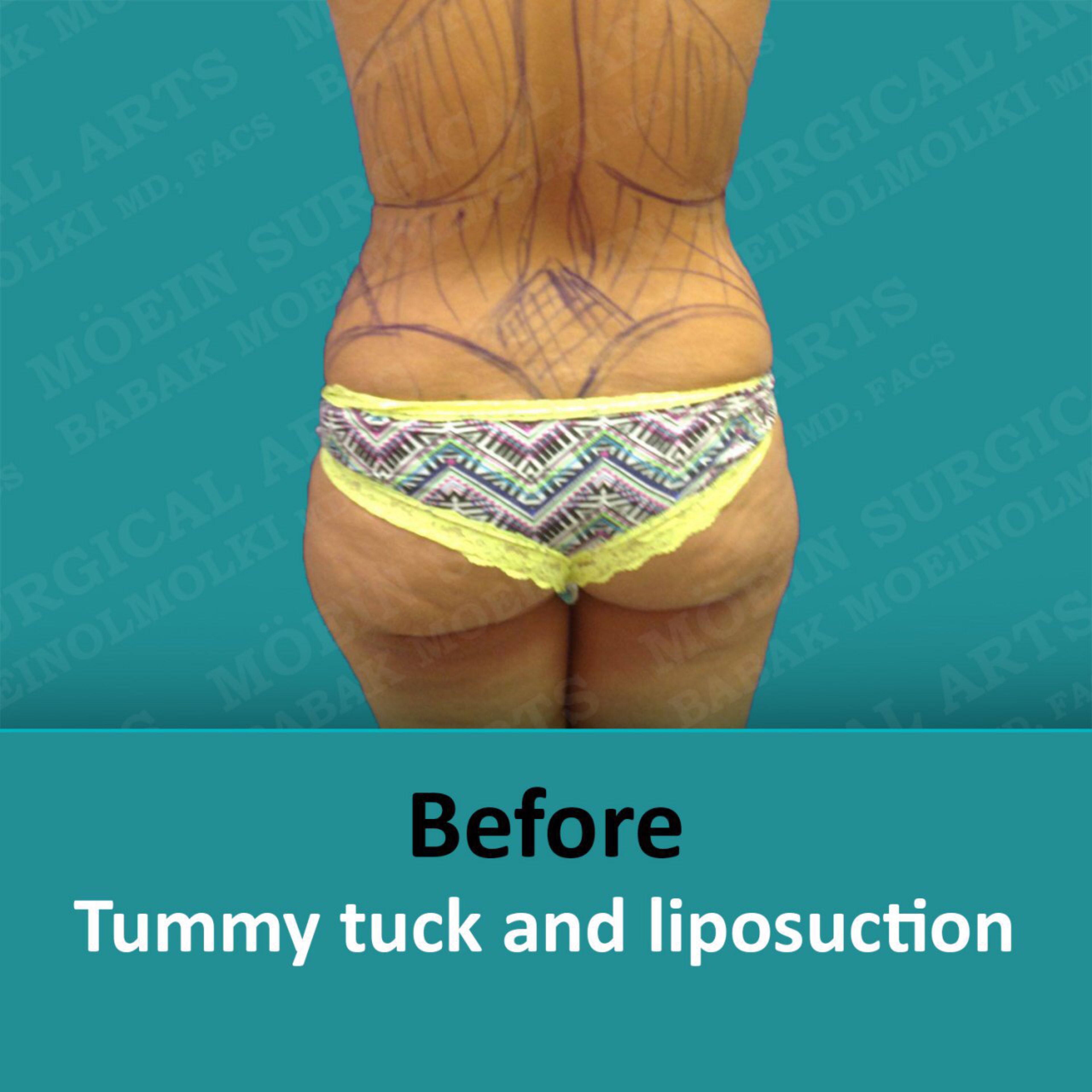 tummy tuck process before