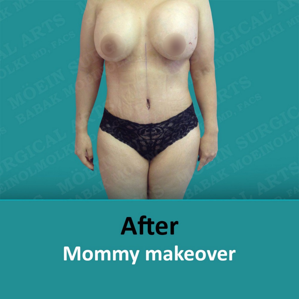 Mommy makeover after