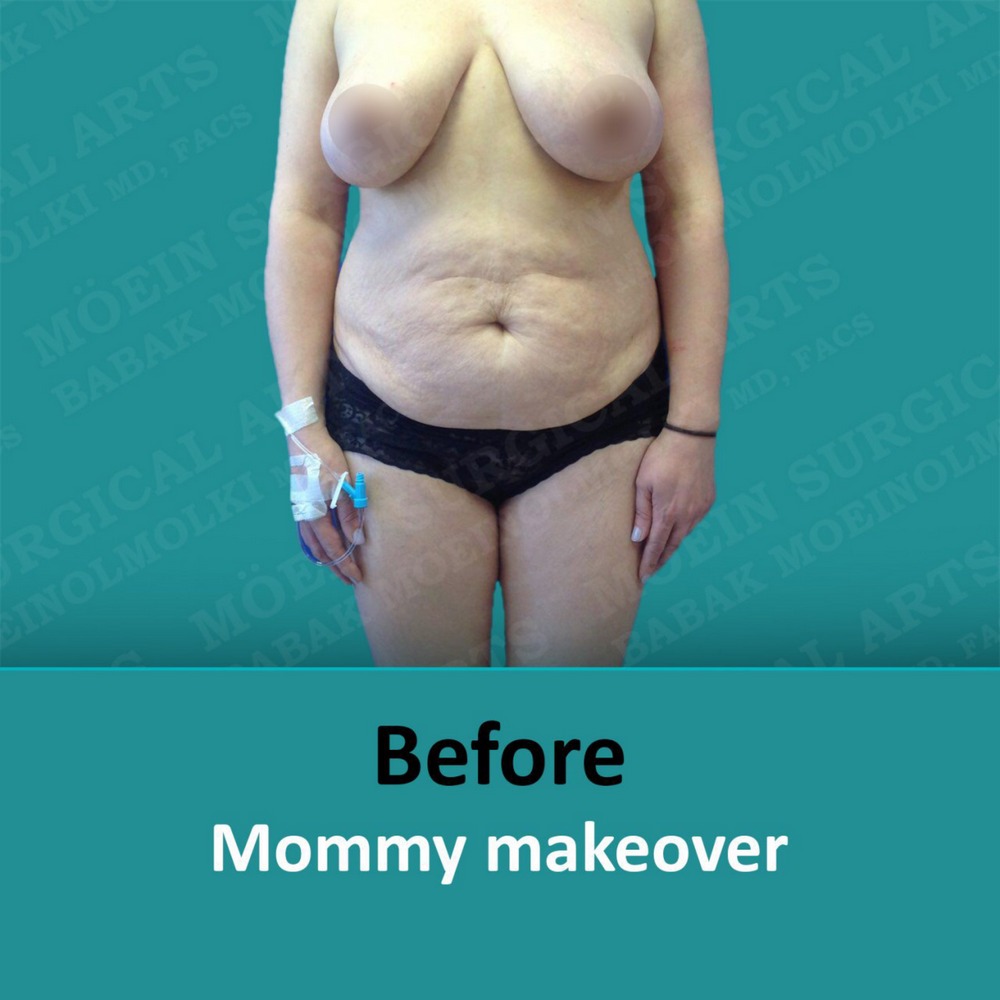 Mommy makeover before