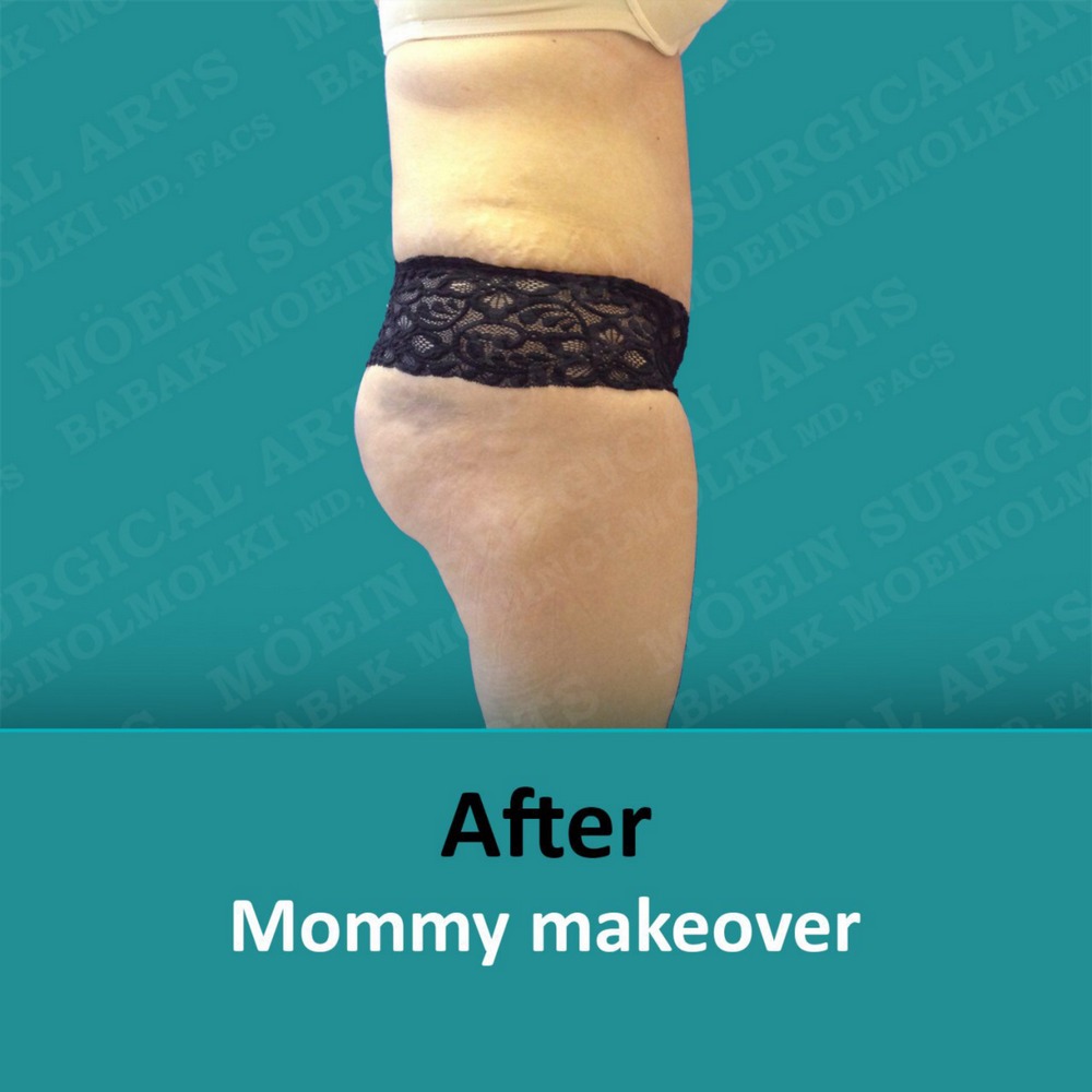 mommy makeover surgery after