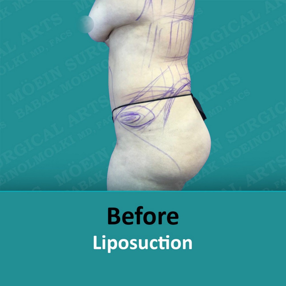 smaller waist surgery before