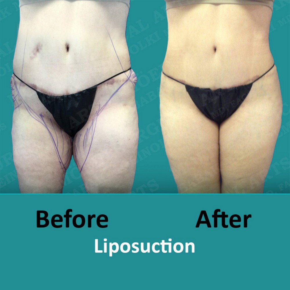 lipo of body before and after