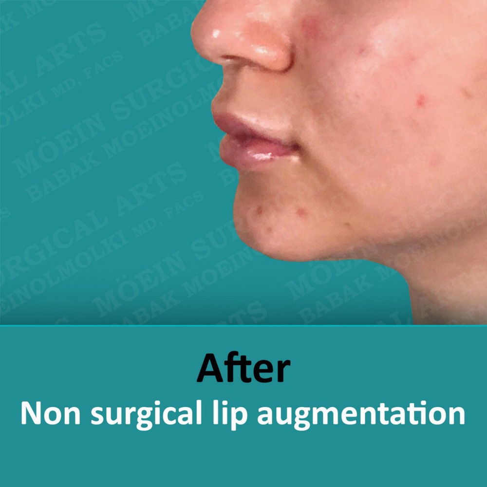 LIP AUGMENTATION after result