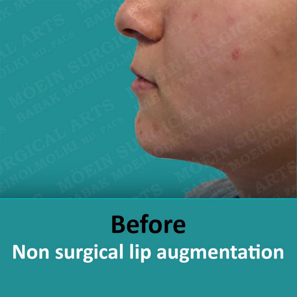 LIP AUGMENTATION before result