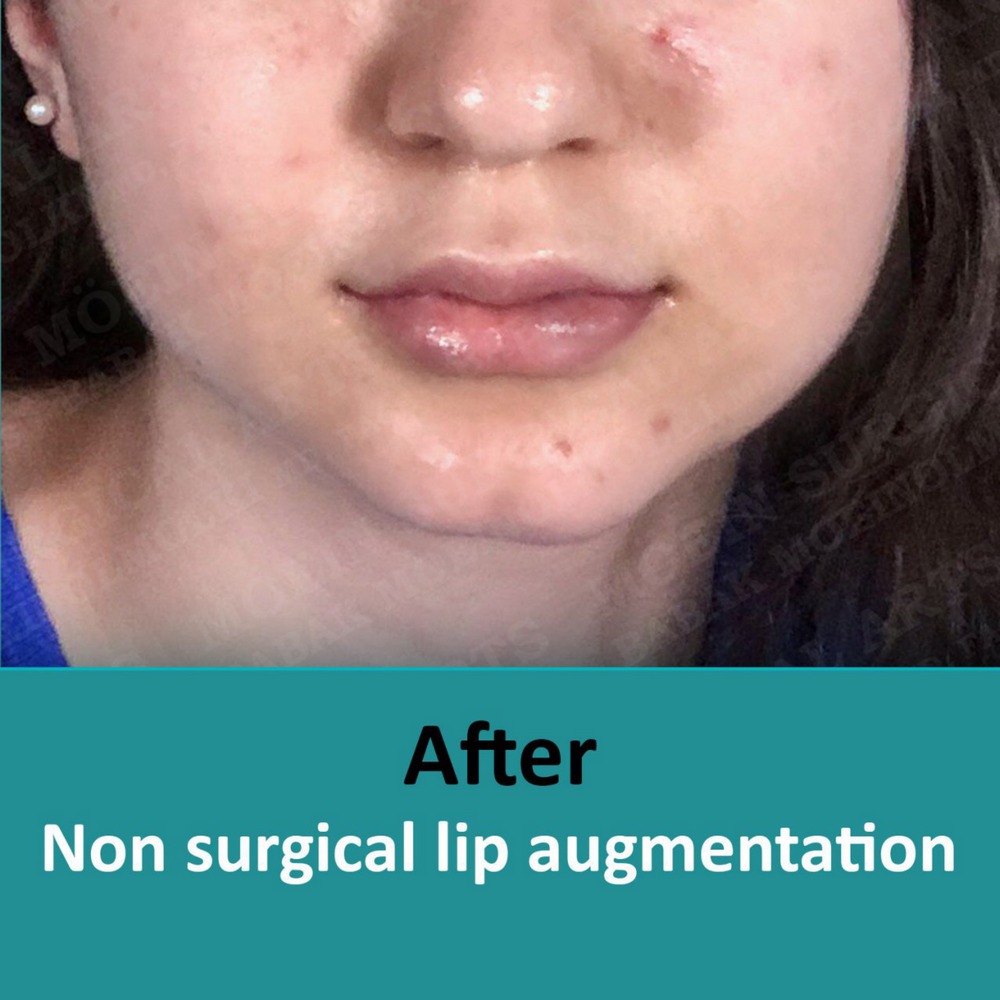 LIP AUGMENTATION after