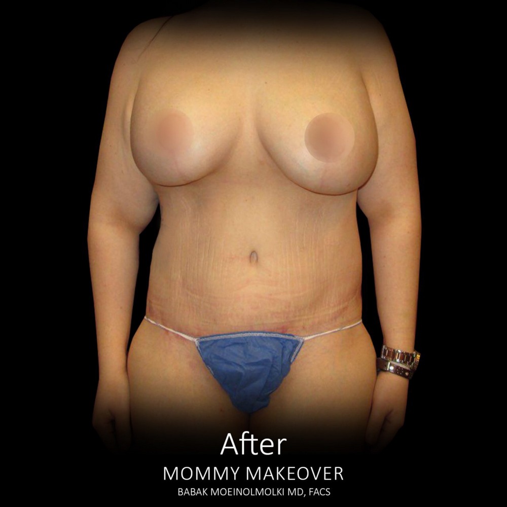 mommy makeover surgery after