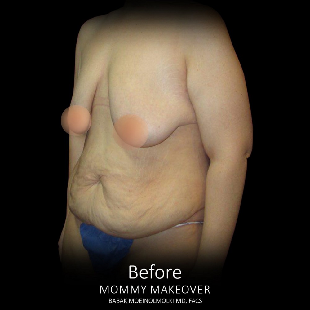 mommy makeover procedure before