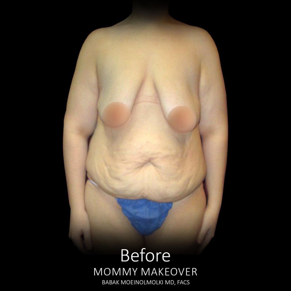 mommy makeover surgery before