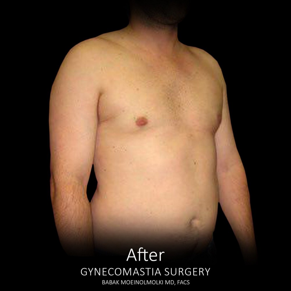 male breast plastic surgery after