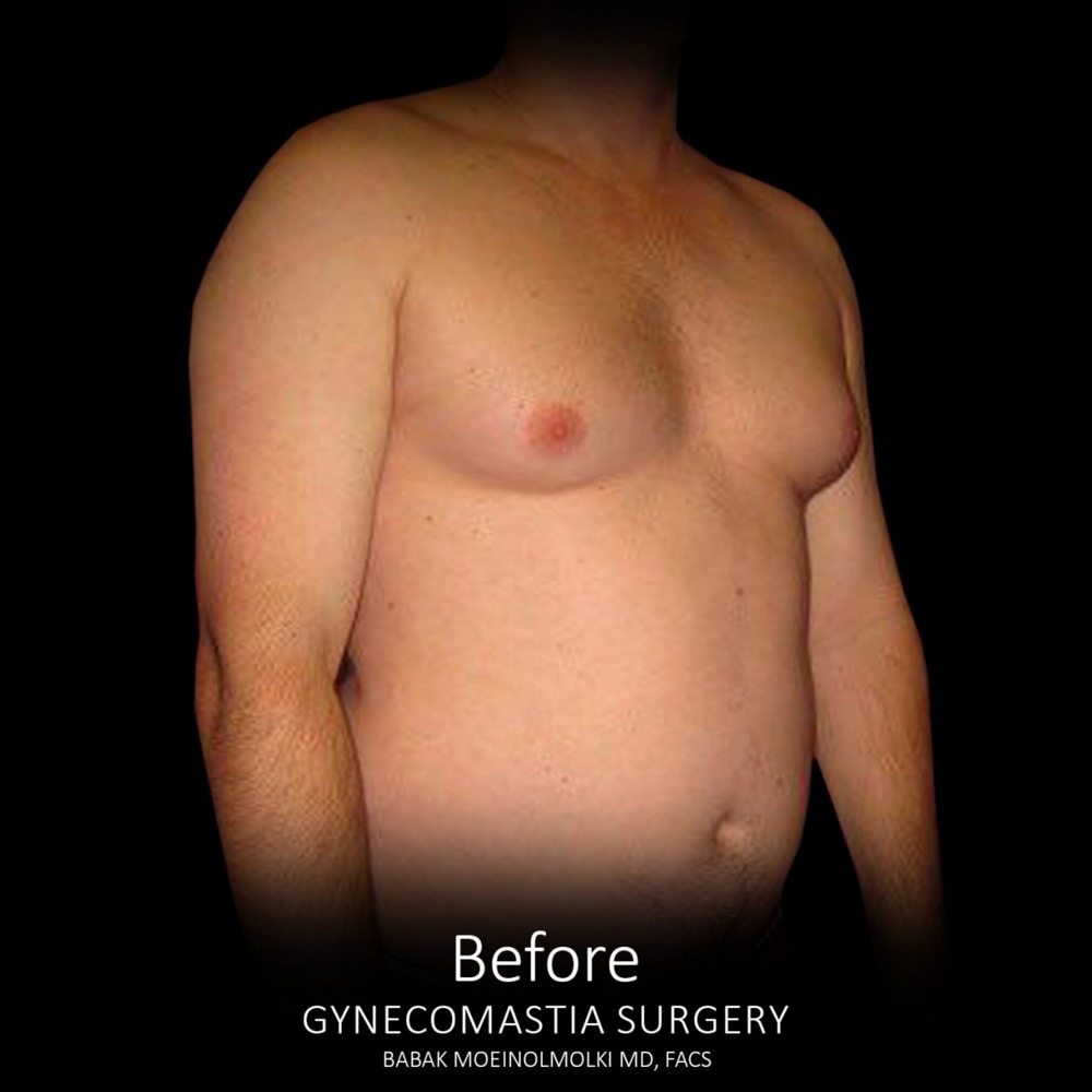 male breast plastic surgery before