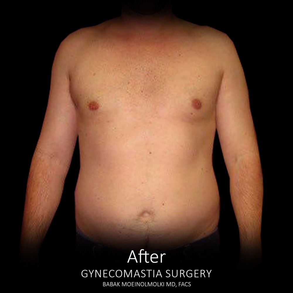 male breast removal after