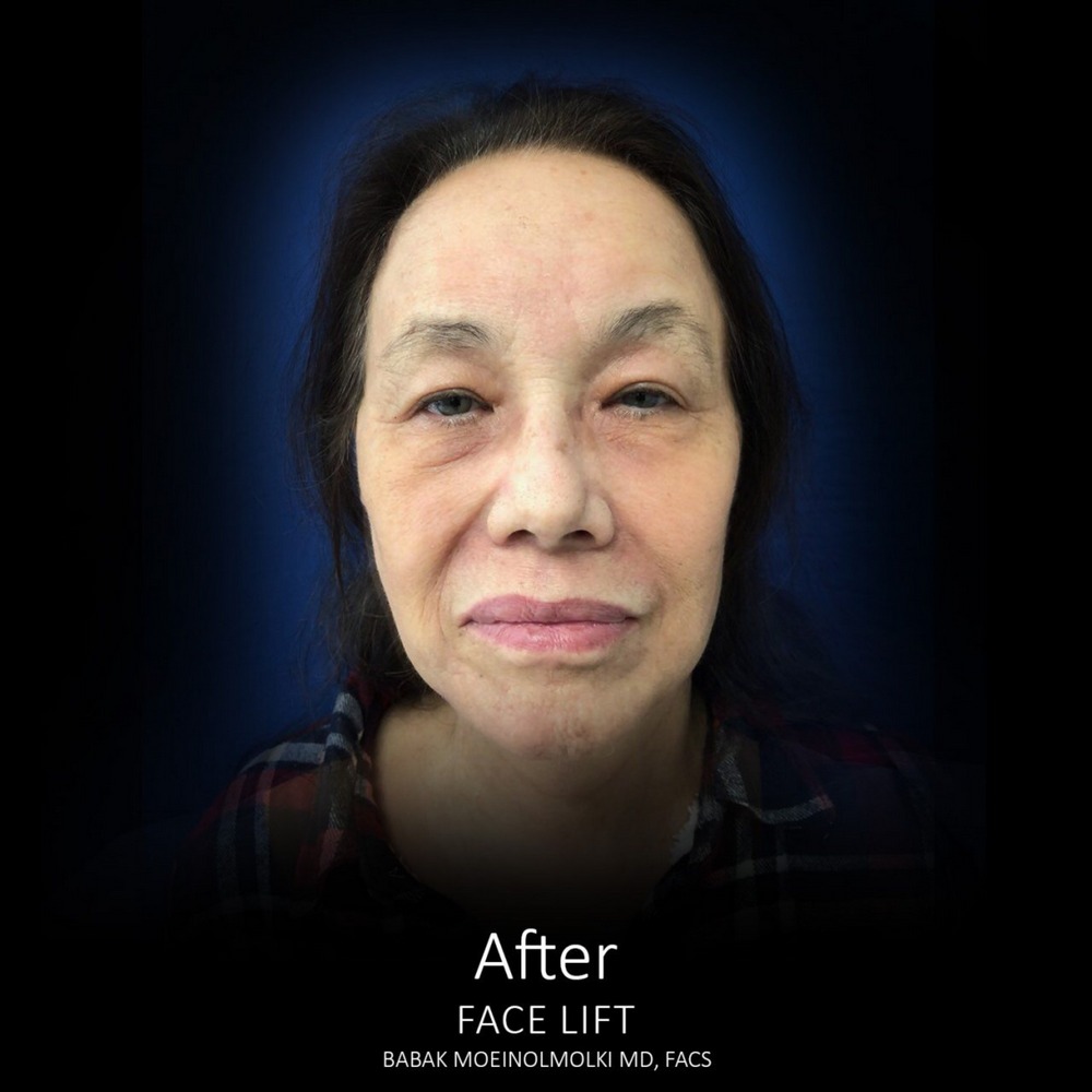 natural face lift after