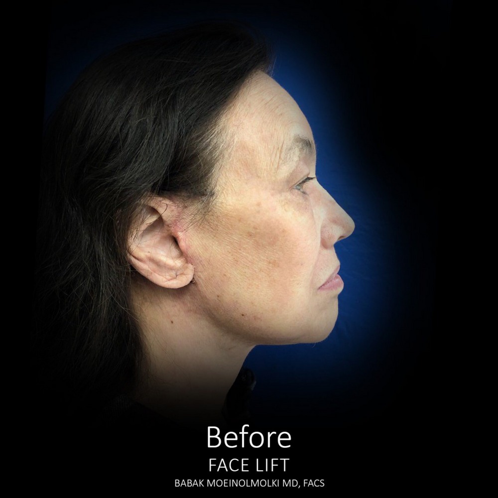 face lift procedure after