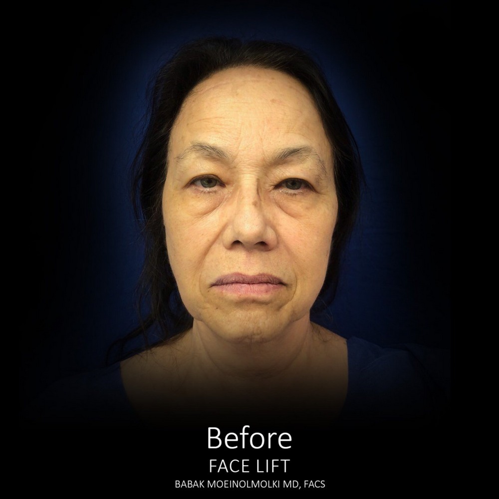 natural face lift before