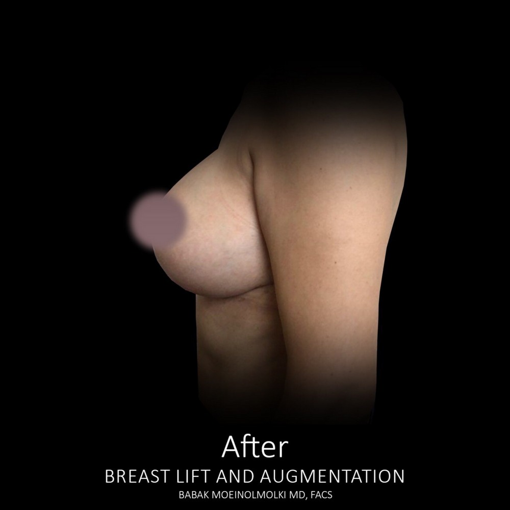 recovery after breast lift and augmentation