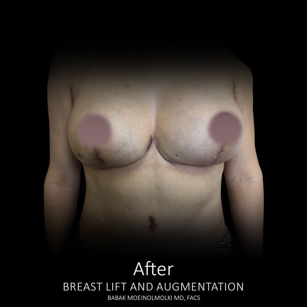 breast lift and augmentation surgery scar after