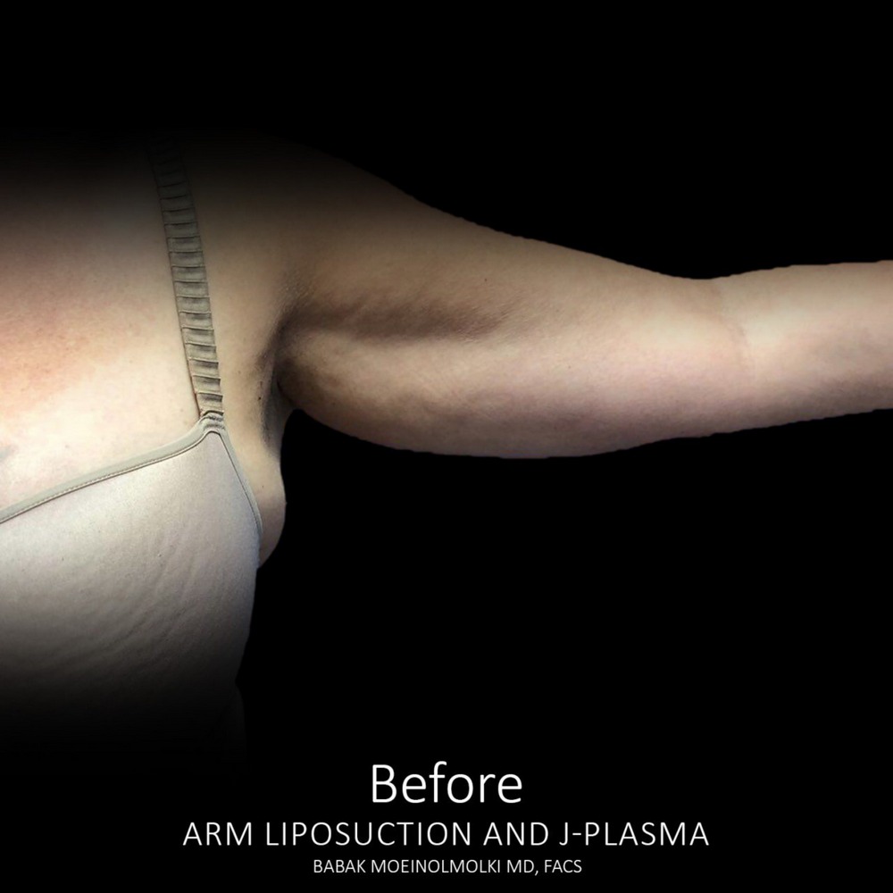 smart lipo arms before
