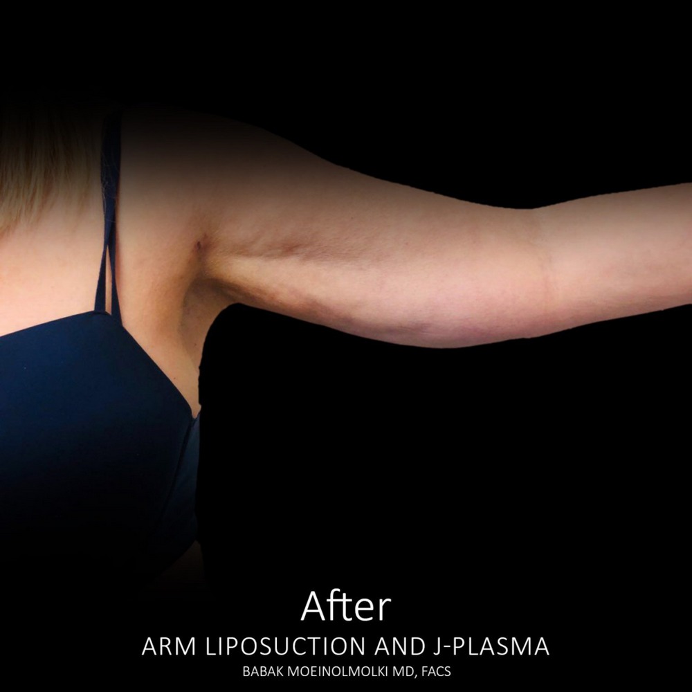 smart lipo arms after