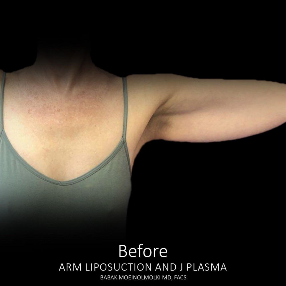 arm reduction before