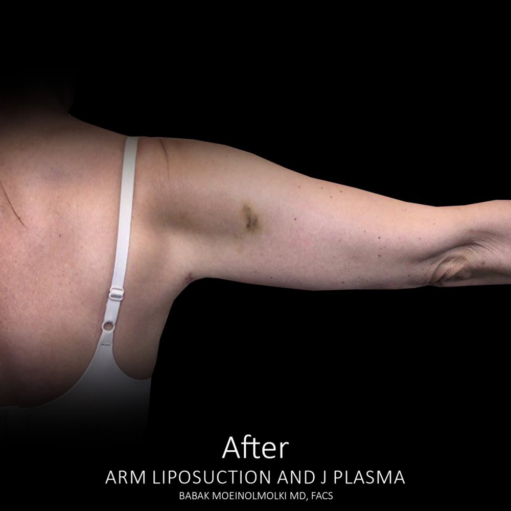 take fat out of arms after