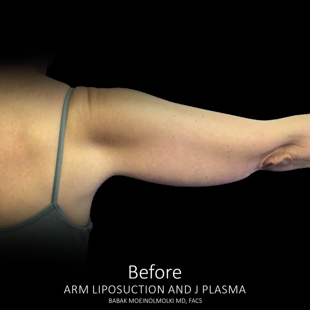 take fat out of arms before