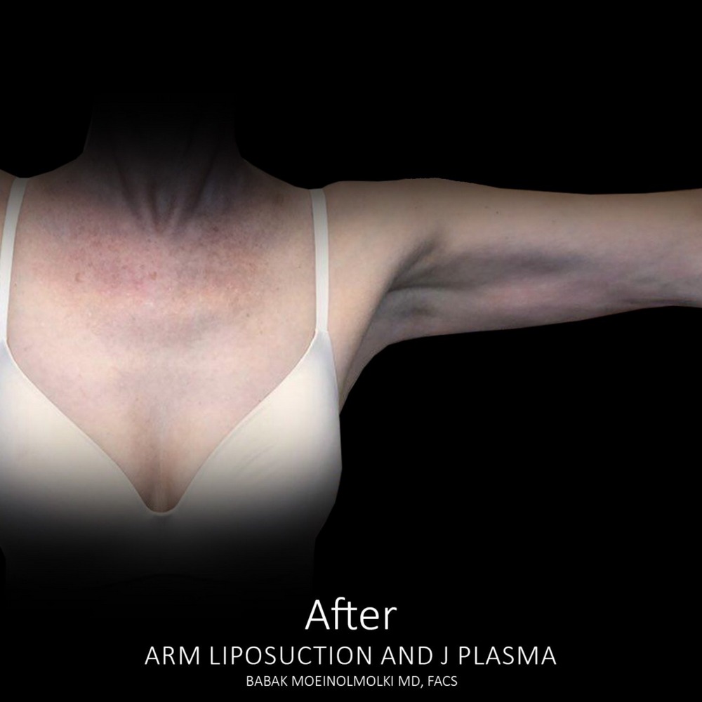 arm reduction after
