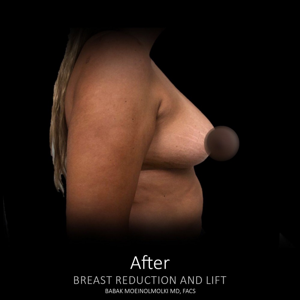 Breast lift before surgery after photo