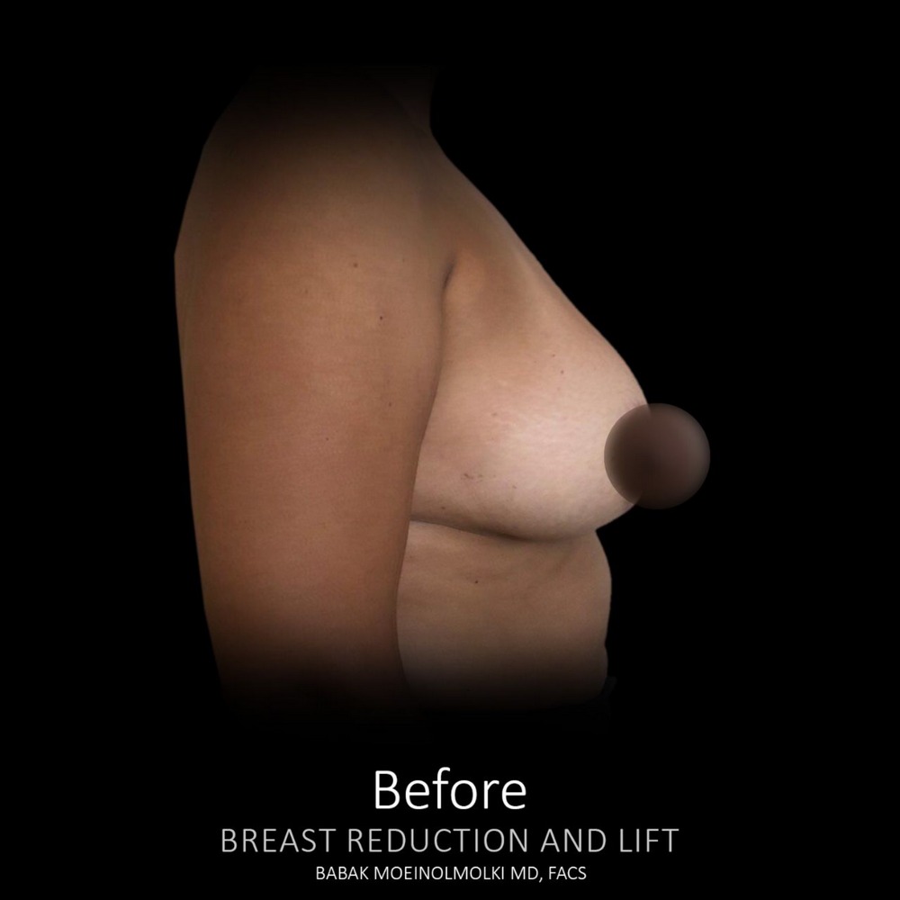 Breast lift before surgery photo