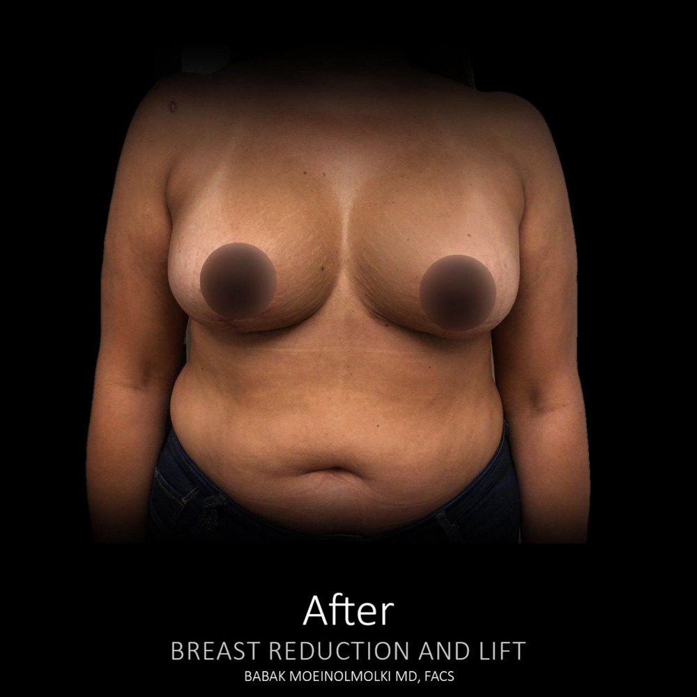 breast lift procedure after image