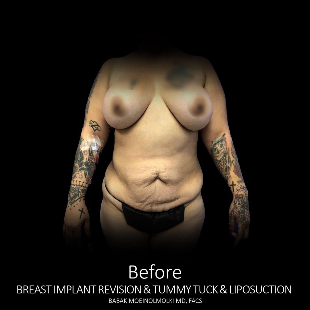 Before Tummy Tuck